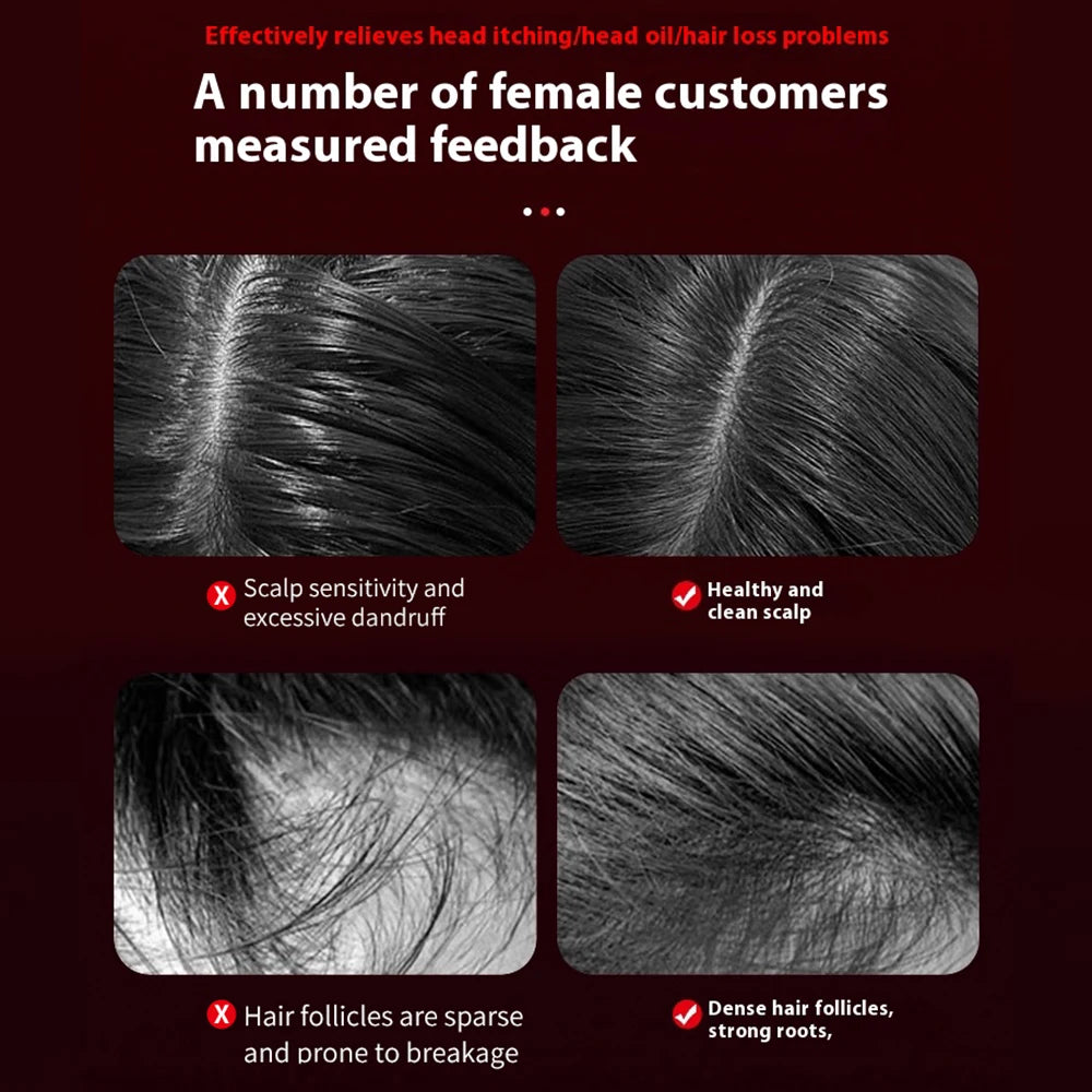 VITALBEAM FOLLICLE ACTIVATOR
